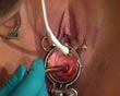 cervix sonde vagina untersuchung fotze