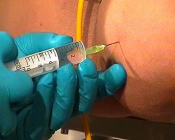 spritzen injectionen popospritze clinic klinik nacl
